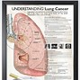 Image result for Cancerous Lung Nodules