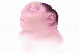 Image result for Exencephaly vs Anencephaly