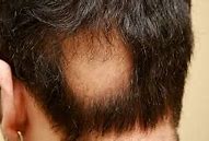Image result for alopeciz