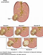 Image result for Complex Kidney Cyst Size
