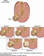 Image result for 7Mm Cyst