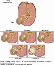 Image result for Renal Cyst 4 Cm