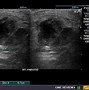 Image result for Parotid Cyst Ultrasound