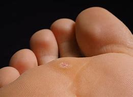 Image result for Wart On Heel of Foot