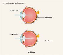 Image result for Astigmatism Glasses