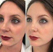 Image result for Vi Peel Process