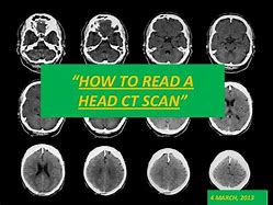 Image result for Nexus Criteria for CT Scans