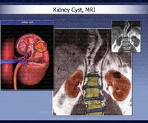 Image result for Severe Kidney Cyst