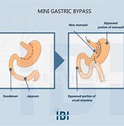 Image result for What Is a Mini Gastric Bypass