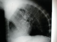 Image result for Kyphosis Back Brace for Posture