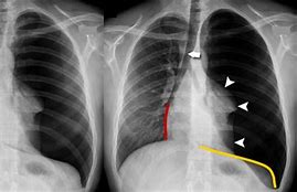 Image result for Tension Pneumothorax Chest X-ray