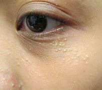 Image result for Small White Bumps On Skin