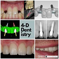 Image result for Dental Implant Lateral Incisor