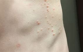 Image result for Molluscum Contagiosum White Core