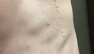 Image result for Molluscum Contagiosum in Groin Adult