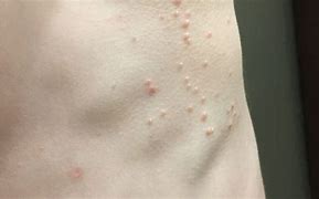 Image result for Molluscum Contagiosum Over the Counter