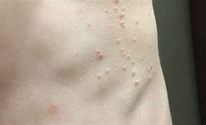 Image result for Molloscum in Toddlers