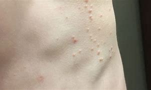 Image result for Molluscum Contagiosum in Adults
