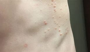 Image result for Skin Virus Molluscum