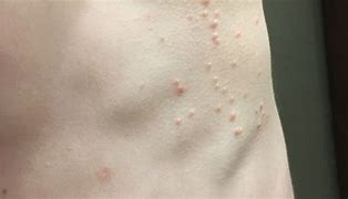 Image result for Molluscum Contagiosum Images in Children