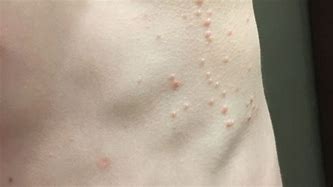 Image result for Molluscum Contagiosum Look Like When Getting Better