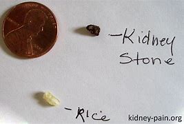 Image result for What Does a 4 mm Kidney Stone Look Like