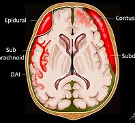 Image result for Intracranial Brain Hemorrhage