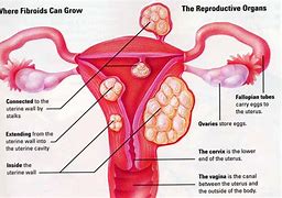 Image result for What Is a Fibroid Cyst in the Uterus