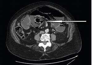 Image result for Bowel Perforation From Paracentesis