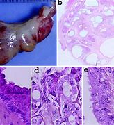 Image result for Teratoma Baby Boy