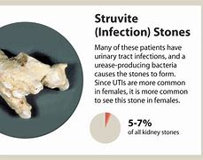 Image result for Struvite Kidney Stones