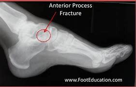 Image result for Calcaneus Fracture
