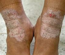 Image result for Eczema On Dark Skin