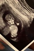Image result for Anencephaly Black Baby