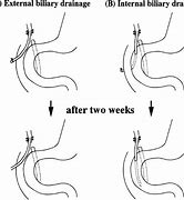 Image result for Internal Biliary Drain