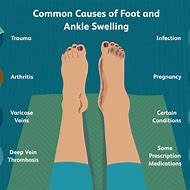 Image result for Left Ankle Swelling