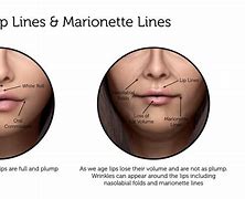 Image result for Lip Lines around Mouth