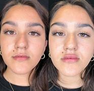 Image result for Lip Line Fillers Before and After