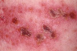 Image result for Shingles Scabs