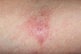 Image result for Molluscum Contagiosum and Eczema