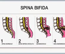 Image result for Spina Bifida Occulta L5