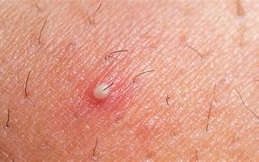 Image result for Ingrown Hair On