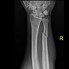 Image result for Jones Fracture