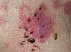 Image result for What Do Bed Bugs Bites Look Like After a Few Days