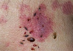 Image result for What Does Bed Bug Bites Look Like