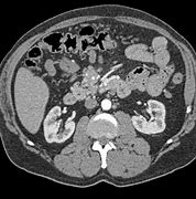 Image result for Carcinoid Tumor CT Scan