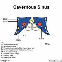 Image result for Cavernous Sinus Syndrome