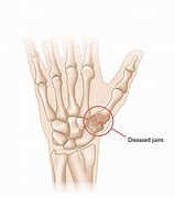 Image result for Thumb CMC Joint Arthritis