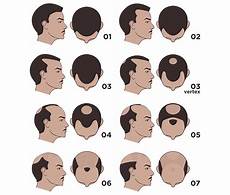 Norwood Scale Pattern Baldness Scale