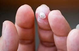Image result for Common Wart Falling Off